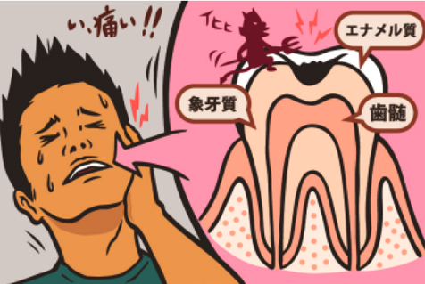 R25忘れたころにやってくる虫歯のメカニズム