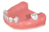 歯を数本失った状態　柴垣歯科医院