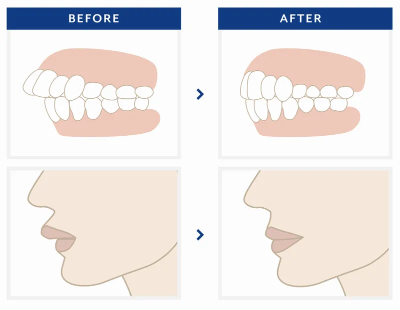 歯科矯正 歯並び上顎前突・出っ歯