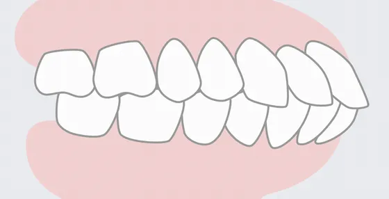 矯正歯科 歯並び上下顎前突