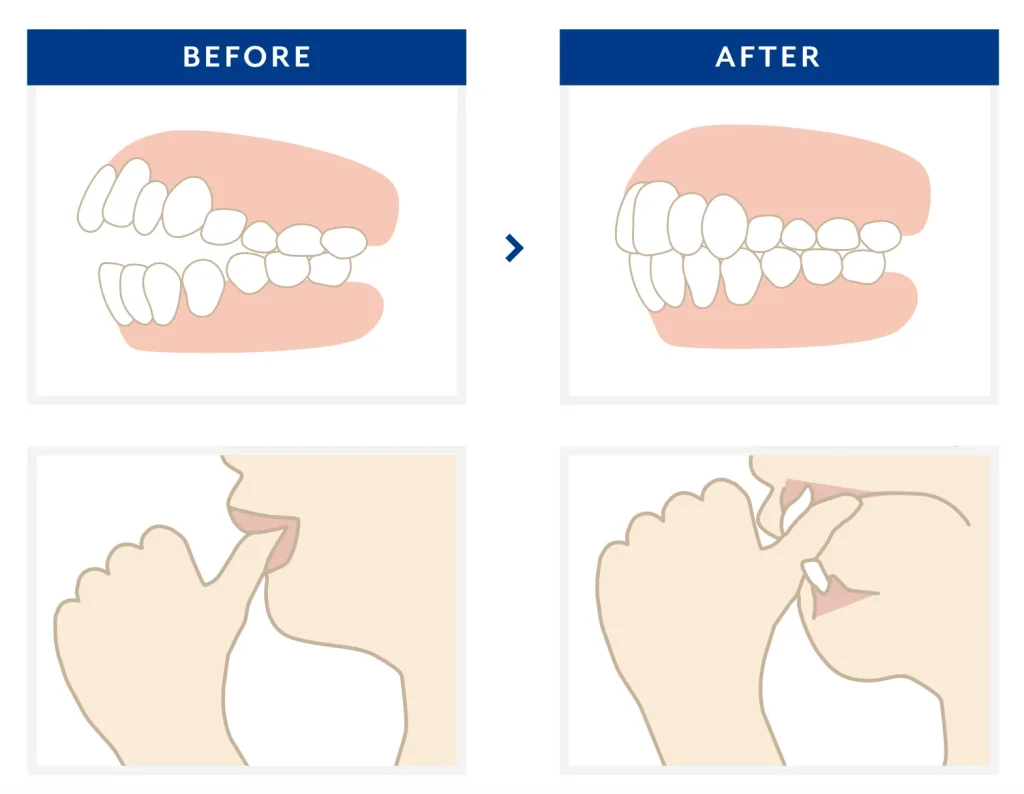 矯正歯科 歯並び開口指しゃぶり・悪習癖