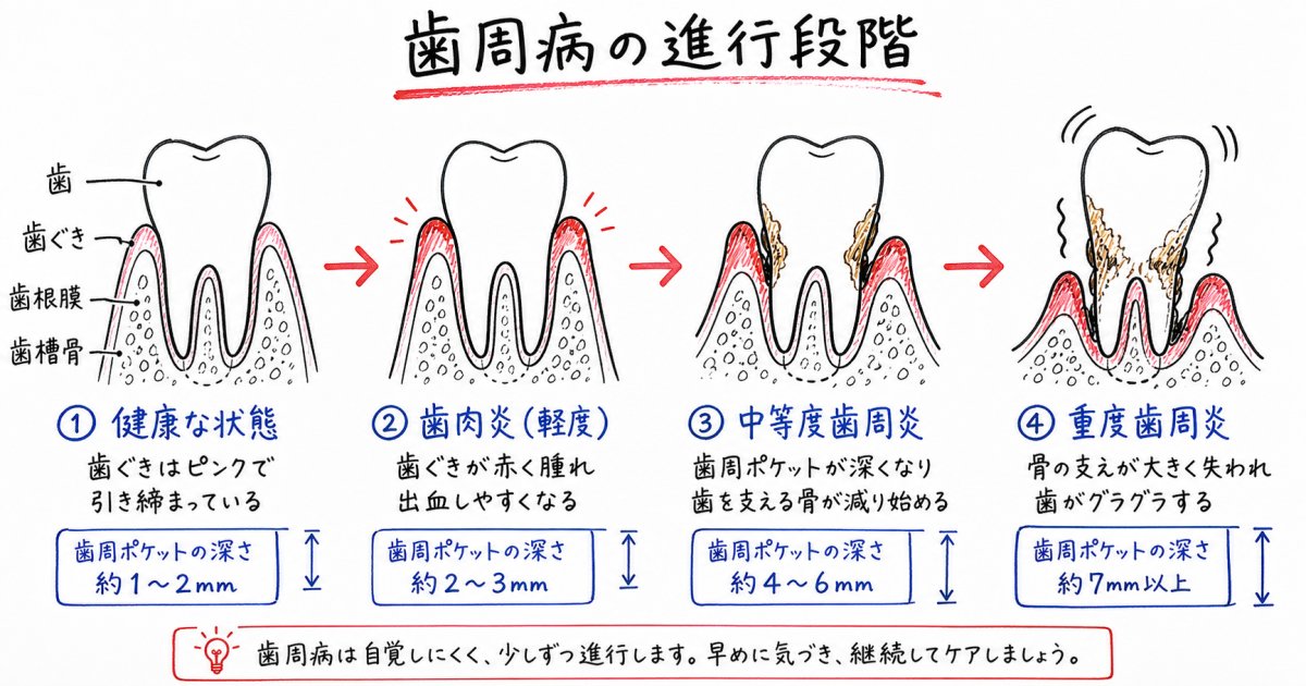 歯周病を放置するとどうなる？歯を失うまでの進行段階とメカニズム