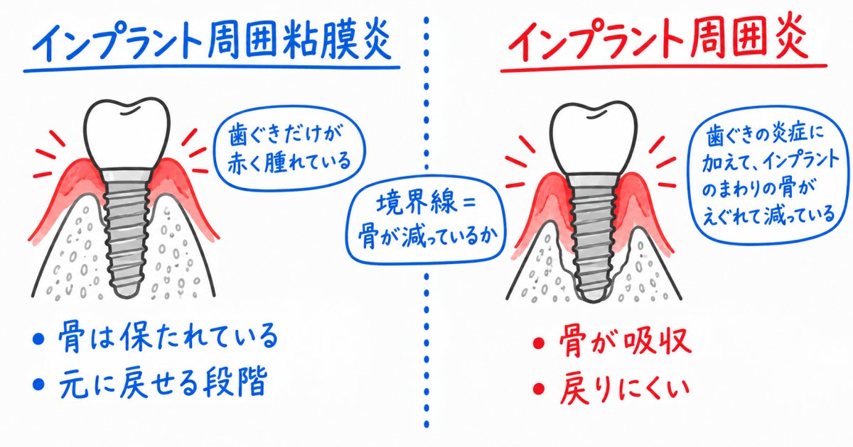 インプラント周囲の出血は見逃せないサイン？初期症状と歯周病との違い
