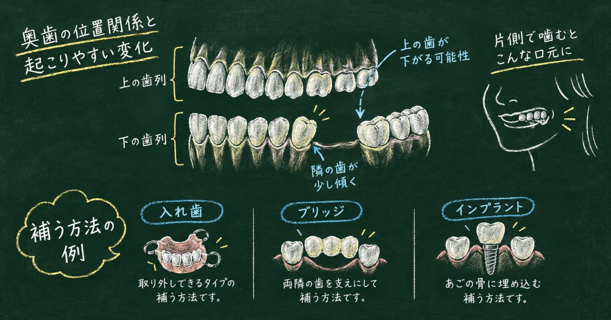 奥歯が抜けて半年放置、上の歯が下がった?痛みがなくても受診すべき?